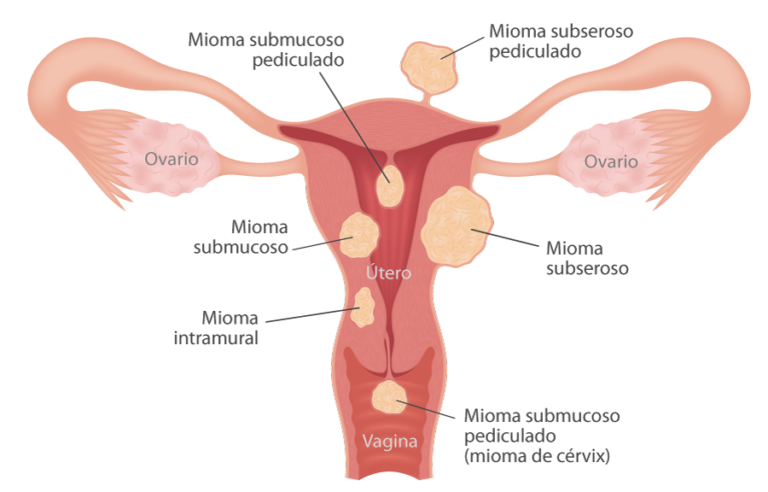 Fibrosis (Miomas en la Matriz)